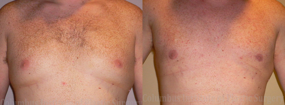Gynecomastia before and after photo by Columbus Institute of Plastic Surgery in Columbus, OH