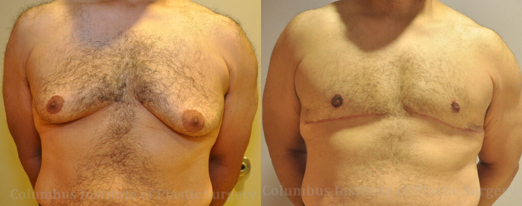 Gynecomastia before and after photo by Columbus Institute of Plastic Surgery in Columbus, OH
