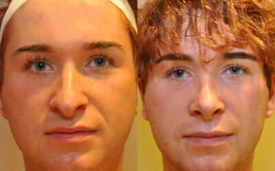 Rhinoplasty before and after photo by Columbus Institute of Plastic Surgery in Columbus, OH Rhinoplasty before and after photo by Columbus Institute of Plastic Surgery in Columbus, OH