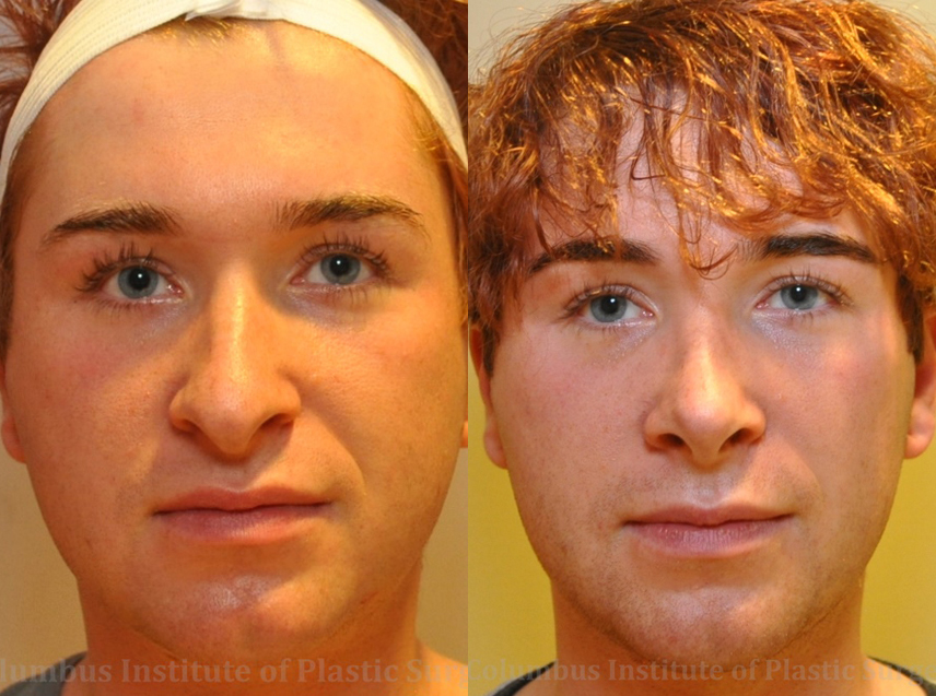 Rhinoplasty before and after photo by Columbus Institute of Plastic Surgery in Columbus, OH