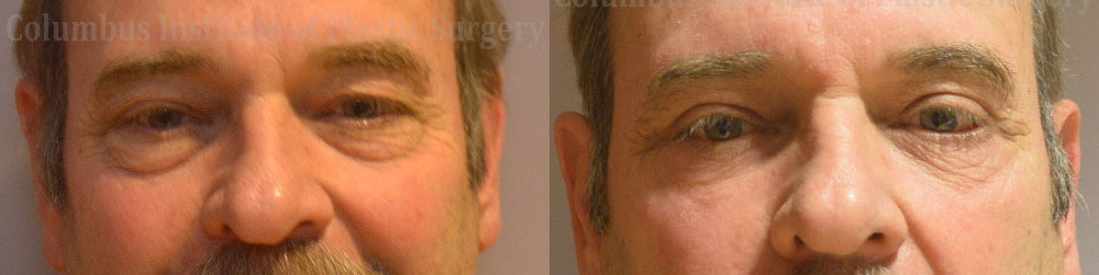 Blepharoplasty before and after photo by Columbus Institute of Plastic Surgery in Columbus, OH