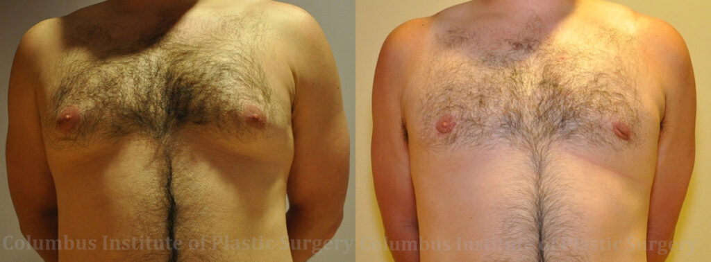 Gynecomastia before and after photo by Columbus Institute of Plastic Surgery in Columbus, OH