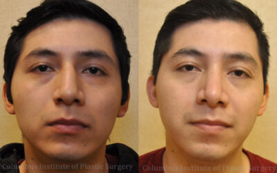 Rhinoplasty before and after photo by Columbus Institute of Plastic Surgery in Columbus, OH Rhinoplasty before and after photo by Columbus Institute of Plastic Surgery in Columbus, OH