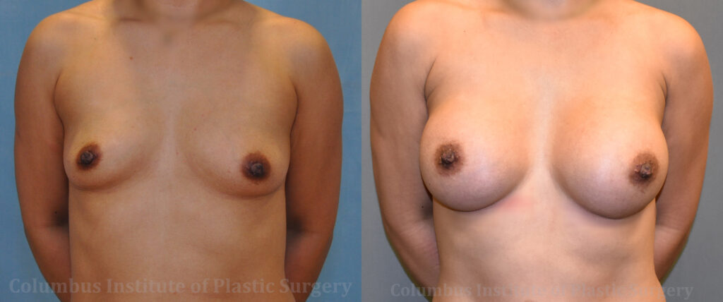 Breast Augmentation before and after photo by Columbus Institute of Plastic Surgery in Columbus, OH