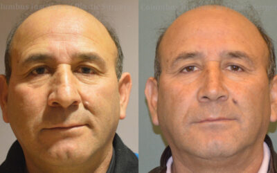Rhinoplasty before and after photo by Columbus Institute of Plastic Surgery in Columbus, OH Rhinoplasty before and after photo by Columbus Institute of Plastic Surgery in Columbus, OH