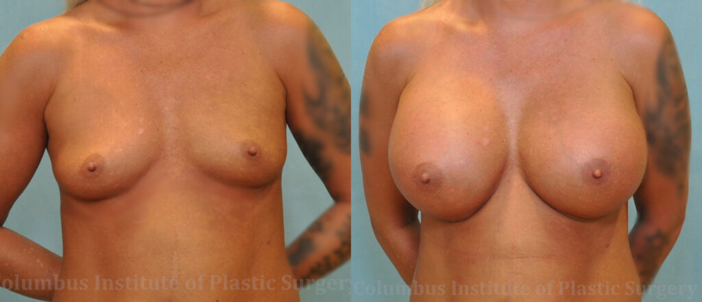 Breast Augmentation before and after photo by Columbus Institute of Plastic Surgery in Columbus, OH