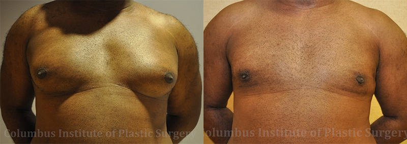 Gynecomastia before and after photo by Columbus Institute of Plastic Surgery in Columbus, OH