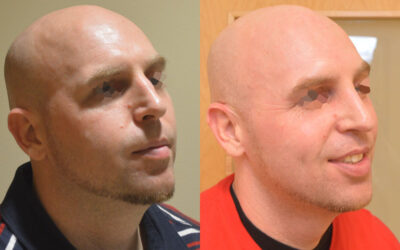 Rhinoplasty before and after photo by Columbus Institute of Plastic Surgery in Columbus, OH Rhinoplasty before and after photo by Columbus Institute of Plastic Surgery in Columbus, OH