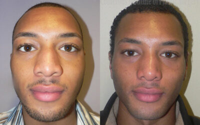 Rhinoplasty before and after photo by Columbus Institute of Plastic Surgery in Columbus, OH Rhinoplasty before and after photo by Columbus Institute of Plastic Surgery in Columbus, OH