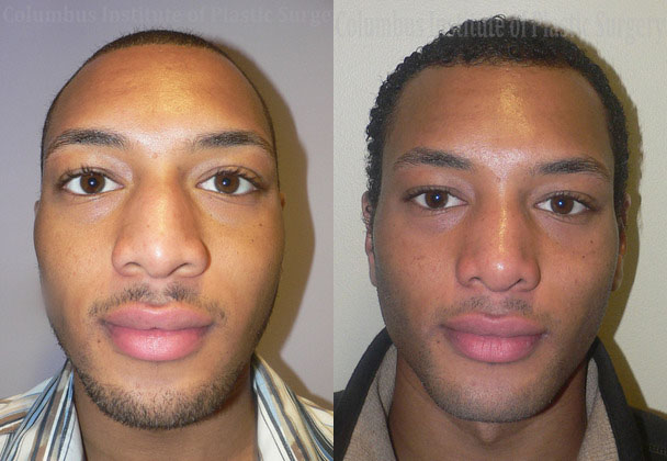Rhinoplasty before and after photo by Columbus Institute of Plastic Surgery in Columbus, OH