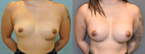 Breast Augmentation before and after photo by Columbus Institute of Plastic Surgery in Columbus, OH