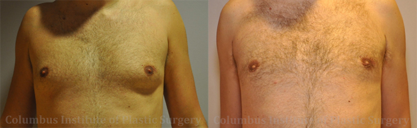 Gynecomastia before and after photo by Columbus Institute of Plastic Surgery in Columbus, OH