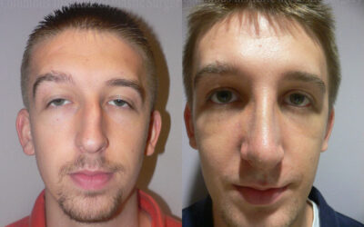 Rhinoplasty before and after photo by Columbus Institute of Plastic Surgery in Columbus, OH Rhinoplasty before and after photo by Columbus Institute of Plastic Surgery in Columbus, OH