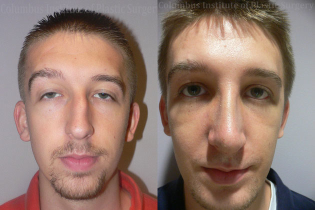 Rhinoplasty before and after photo by Columbus Institute of Plastic Surgery in Columbus, OH