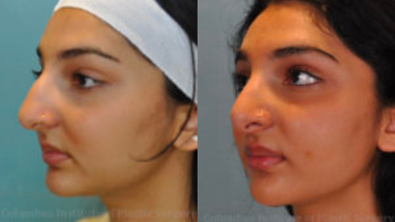 CIPS Rhinoplasty Before + After CIPS Rhinoplasty Before + After