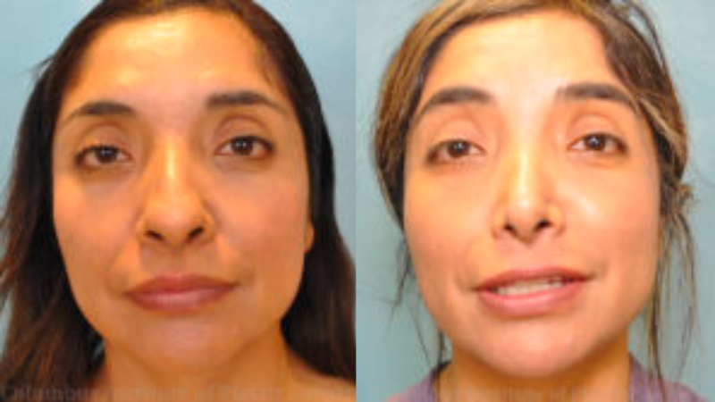 CIPS Rhinoplasty Before + After CIPS Rhinoplasty Before + After