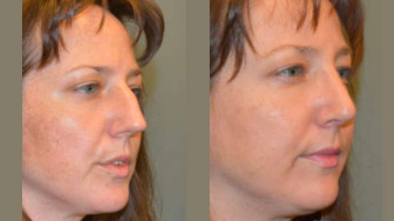 CIPS Rhinoplasty Before + After CIPS Rhinoplasty Before + After