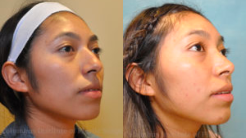 CIPS Rhinoplasty Before + After CIPS Rhinoplasty Before + After