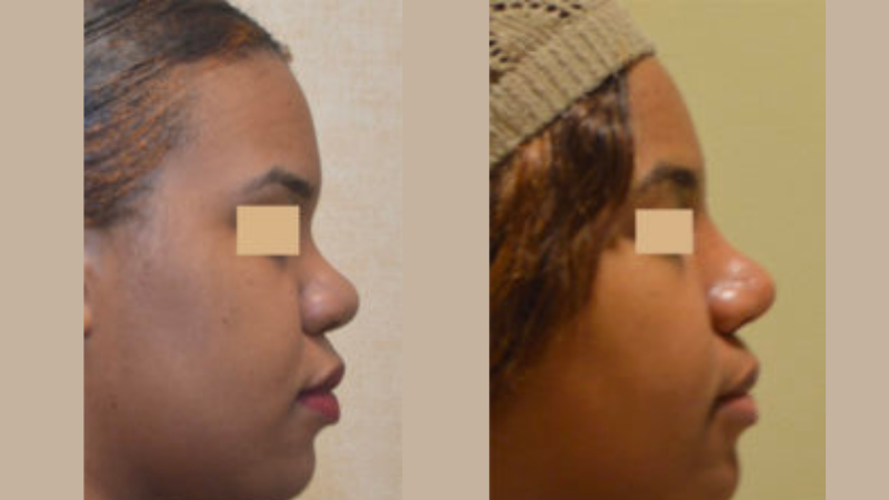 CIPS Rhinoplasty Before + After CIPS Rhinoplasty Before + After