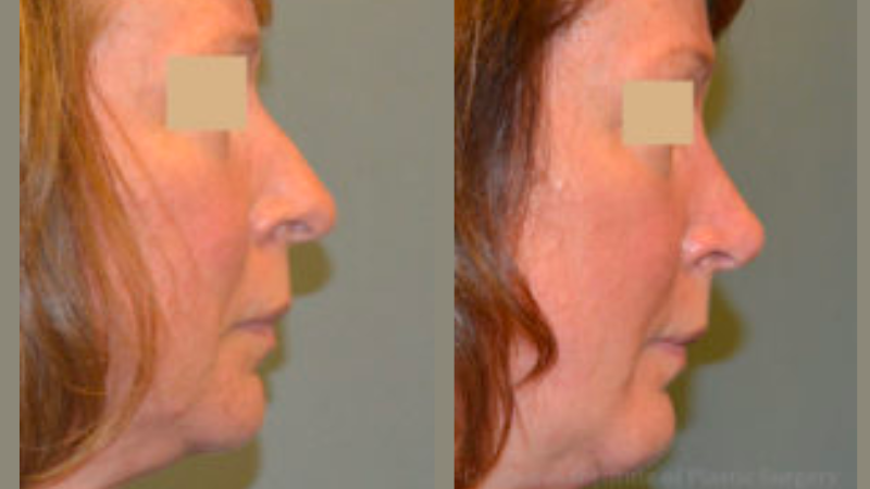CIPS Rhinoplasty Before + After CIPS Rhinoplasty Before + After