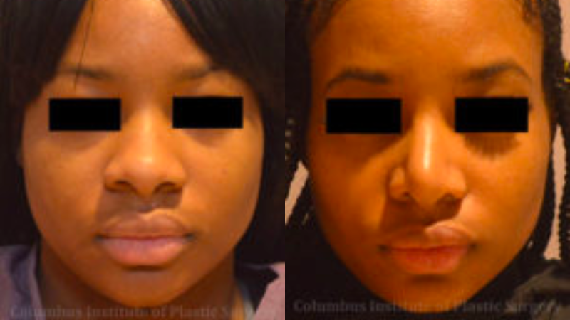 CIPS Rhinoplasty Before + After CIPS Rhinoplasty Before + After