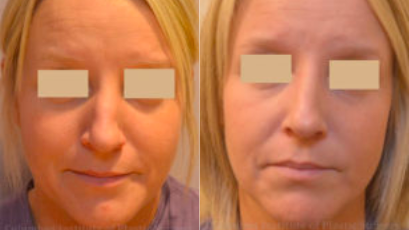 CIPS Rhinoplasty Before + After CIPS Rhinoplasty Before + After