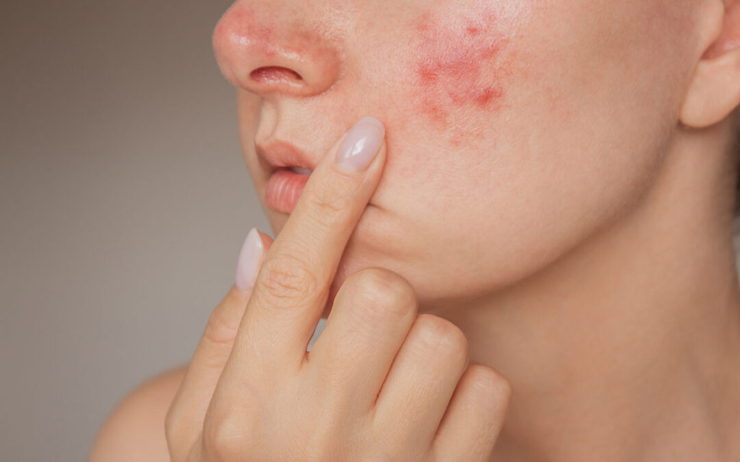 Close-up photo of a young Caucasian woman suffering from the skin chronic disease rosacea on her face in the acute stage