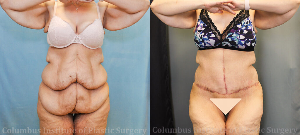 Abdominoplasty after Weight Loss before and after photo by Columbus Institute of Plastic Surgery in Columbus, OH