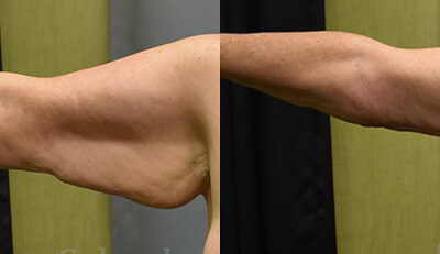 Brachioplasty (Arm Lift) before and after photo by Columbus Institute of Plastic Surgery in Columbus, OH Brachioplasty (Arm Lift) before and after photo by Columbus Institute of Plastic Surgery in Columbus, OH