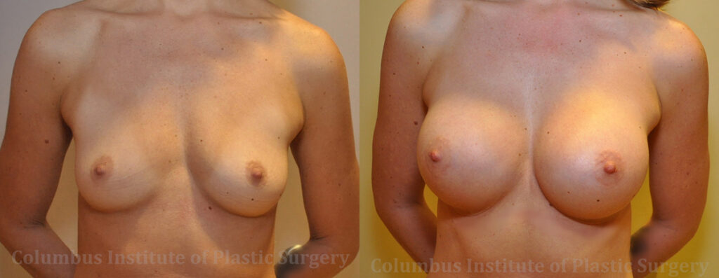 Breast Augmentation – 200cc-300cc before and after photo by Columbus Institute of Plastic Surgery in Columbus, OH