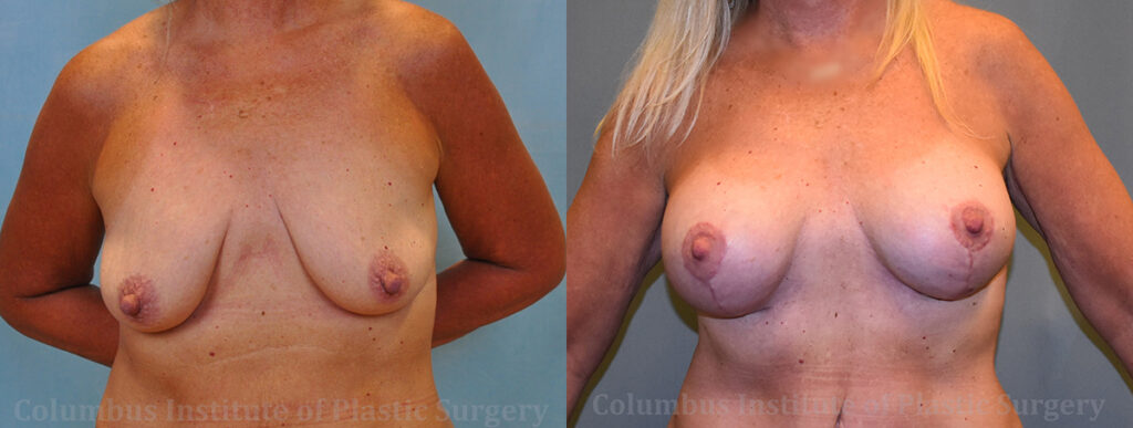 Breast Augmentation – 400cc-500cc before and after photo by Columbus Institute of Plastic Surgery in Columbus, OH