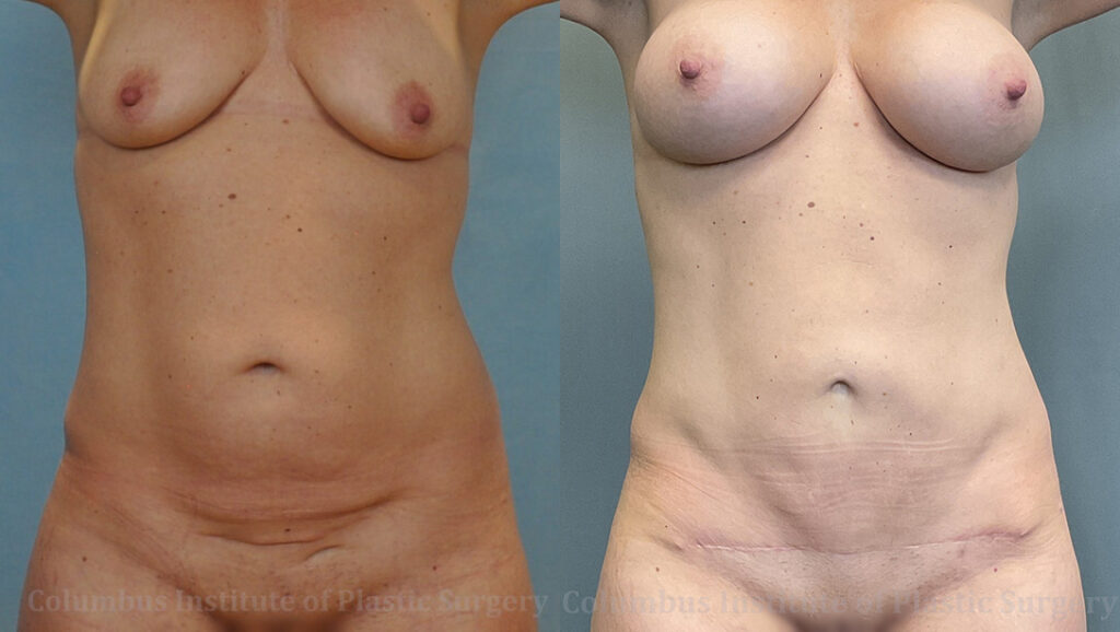 Liposuction before and after photo by Columbus Institute of Plastic Surgery in Columbus, OH