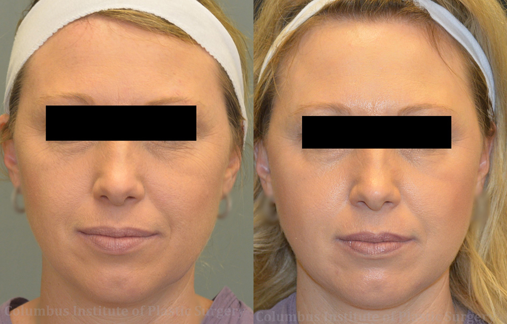 TCA Chemical Peel before and after photo by Columbus Institute of Plastic Surgery in Columbus, OH