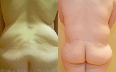 Belt Lipectomy before and after photo by Columbus Institute of Plastic Surgery in Columbus, OH Belt Lipectomy before and after photo by Columbus Institute of Plastic Surgery in Columbus, OH