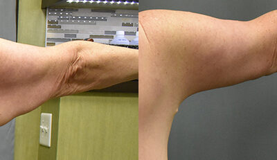 Brachioplasty (Arm Lift) before and after photo by Columbus Institute of Plastic Surgery in Columbus, OH Brachioplasty (Arm Lift) before and after photo by Columbus Institute of Plastic Surgery in Columbus, OH