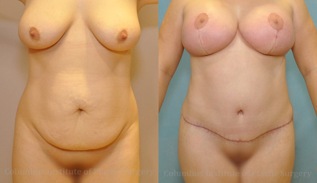Abdominoplasty (Tummy Tuck) before and after photo by Columbus Institute of Plastic Surgery in Columbus, OH