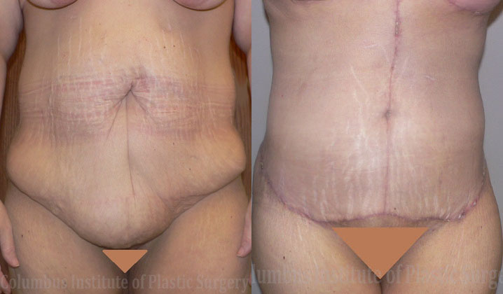 Abdominoplasty after Weight Loss before and after photo by Columbus Institute of Plastic Surgery in Columbus, OH
