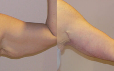 Brachioplasty (Arm Lift) before and after photo by Columbus Institute of Plastic Surgery in Columbus, OH Brachioplasty (Arm Lift) before and after photo by Columbus Institute of Plastic Surgery in Columbus, OH