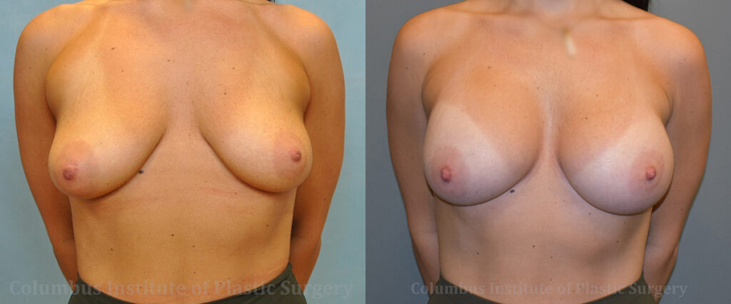 Breast Augmentation – 400cc-500cc before and after photo by Columbus Institute of Plastic Surgery in Columbus, OH