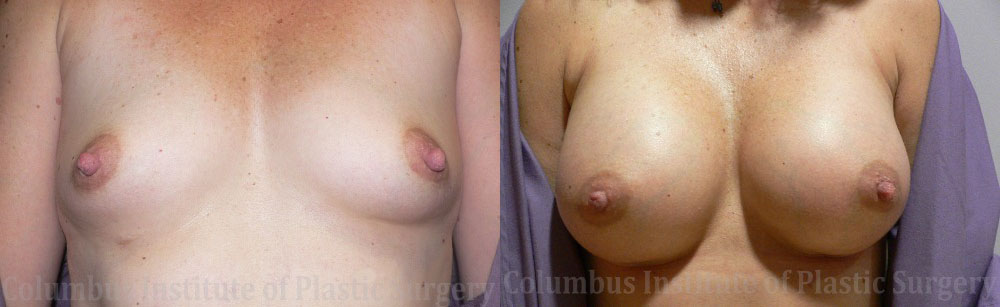 Breast Augmentation – 400cc-500cc before and after photo by Columbus Institute of Plastic Surgery in Columbus, OH