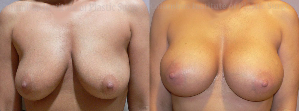 Breast Augmentation – 400cc-500cc before and after photo by Columbus Institute of Plastic Surgery in Columbus, OH