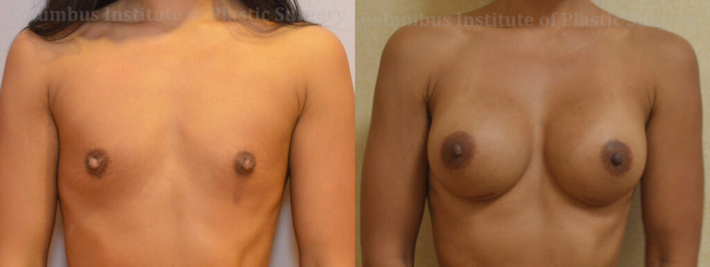 Breast Augmentation before and after photo by Columbus Institute of Plastic Surgery in Columbus, OH