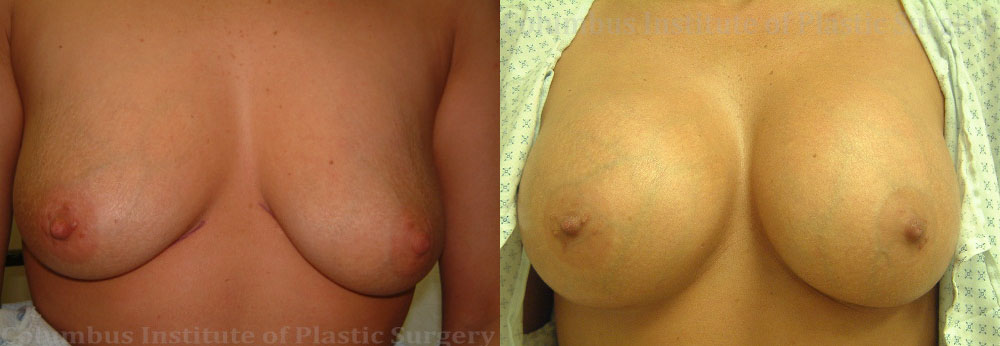 Breast Augmentation – 400cc-500cc before and after photo by Columbus Institute of Plastic Surgery in Columbus, OH