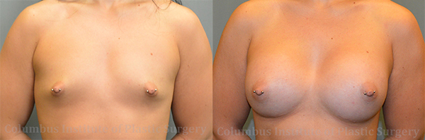 Breast Augmentation before and after photo by Columbus Institute of Plastic Surgery in Columbus, OH