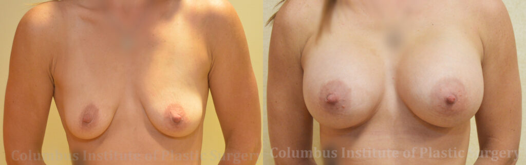 Breast Augmentation before and after photo by Columbus Institute of Plastic Surgery in Columbus, OH