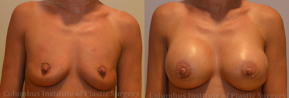 Breast Augmentation before and after photo by Columbus Institute of Plastic Surgery in Columbus, OH