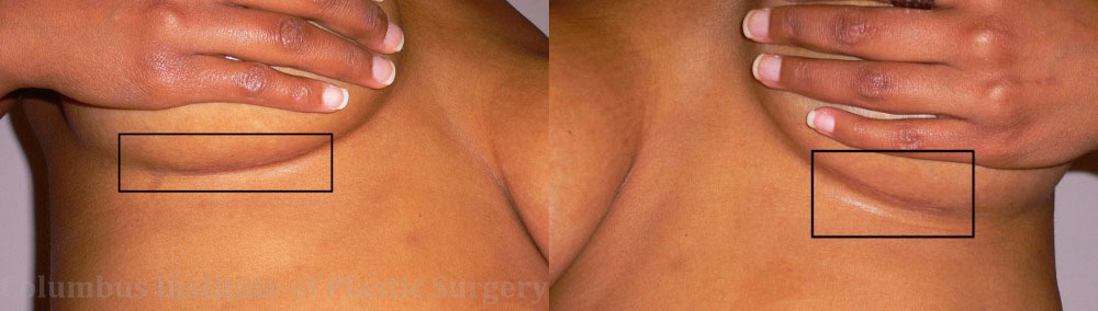 Breast Augmentation – 400cc-500cc before and after photo by Columbus Institute of Plastic Surgery in Columbus, OH