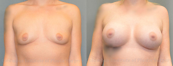 Breast Augmentation before and after photo by Columbus Institute of Plastic Surgery in Columbus, OH