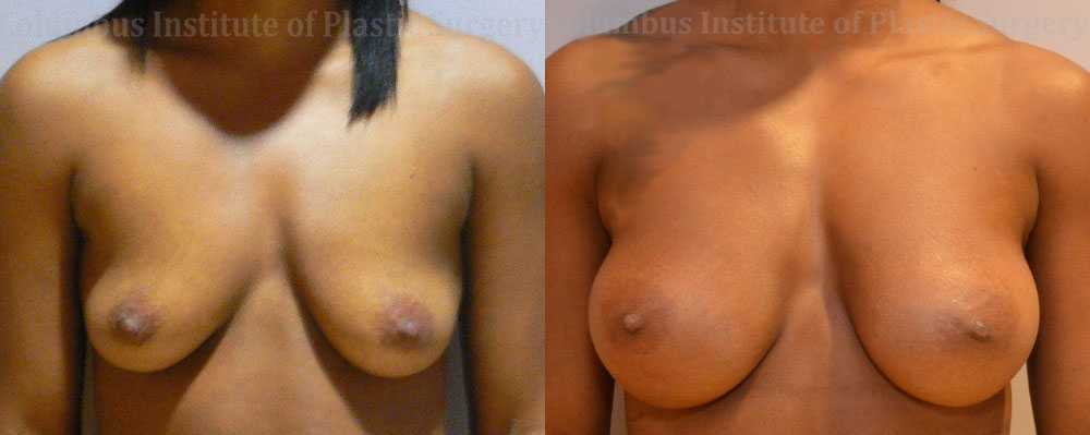 Breast Augmentation – 400cc-500cc before and after photo by Columbus Institute of Plastic Surgery in Columbus, OH