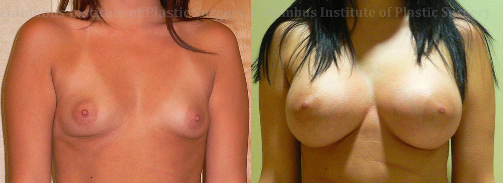 Breast Augmentation before and after photo by Columbus Institute of Plastic Surgery in Columbus, OH